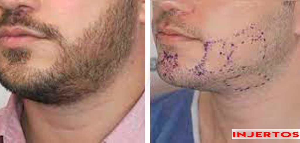  post implante en barba